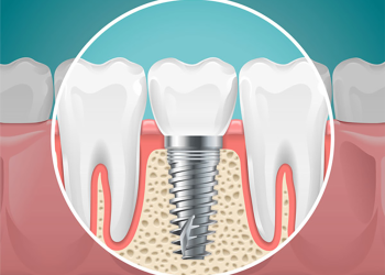 Considering Dental Implants? The Prices in Your Area May Surprise YOU!