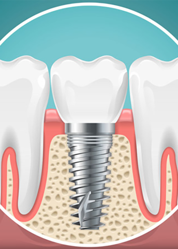 Considering Dental Implants? The Prices in Your Area May Surprise YOU!