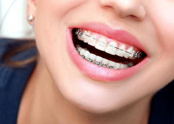The Best 4 Clear Braces for Adults That You Should Seriously Consider!