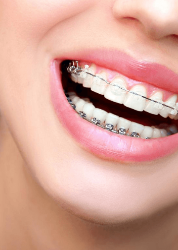 The Best 4 Clear Braces for Adults That You Should Seriously Consider!