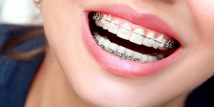 The Best 4 Clear Braces for Adults That You Should Seriously Consider!