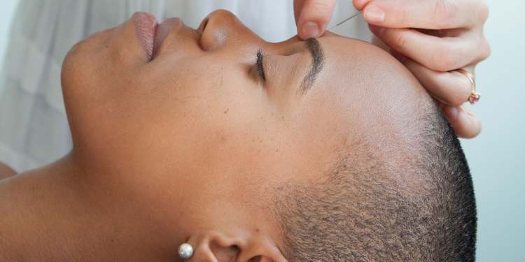 10 Health Benefits of Acupuncture And a Few Minor Risks to Consider