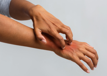 A Full Guide to Psoriasis for Busy People