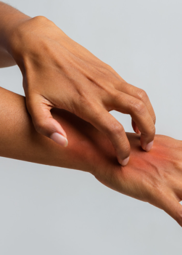 A Full Guide to Psoriasis for Busy People