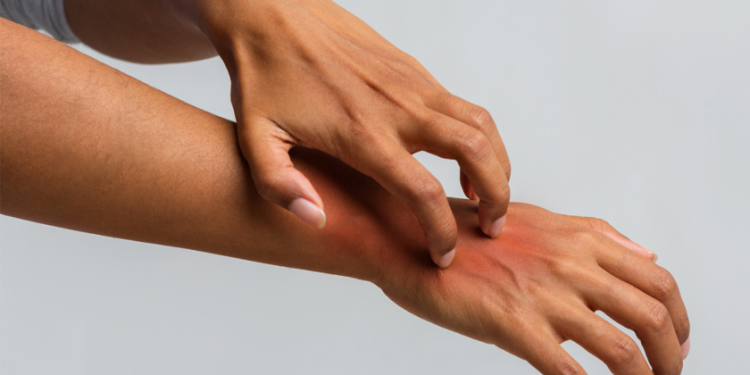 A Full Guide to Psoriasis for Busy People