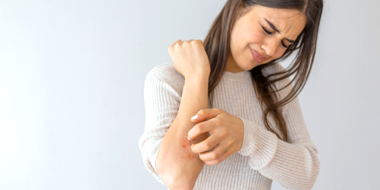 4 Foods That Help Manage Psoriasis